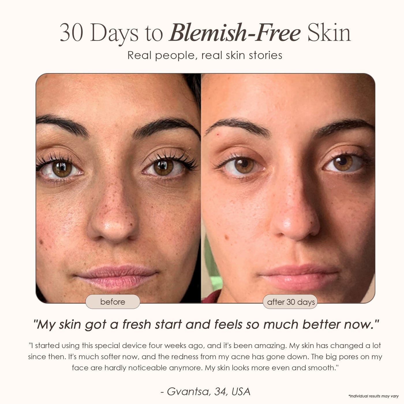 Project E Beauty Skin Care Reinvo | Facial Microdermabrasion Wand